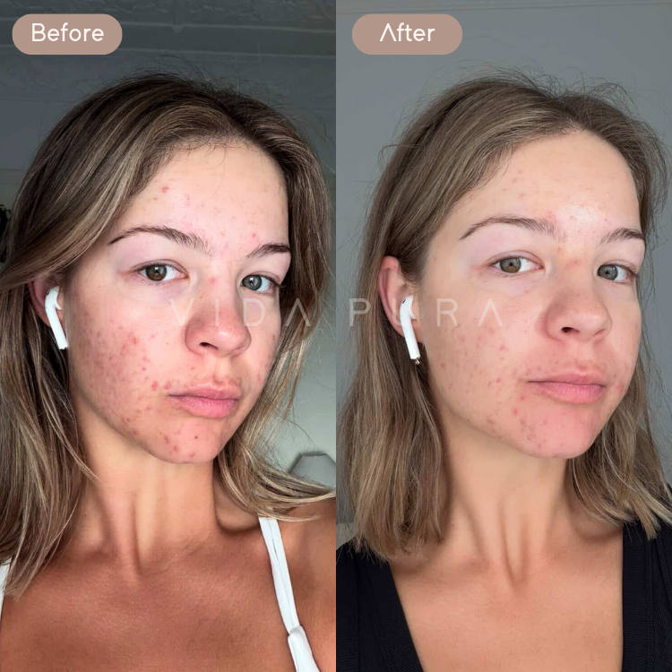 Before and After Vida Pura